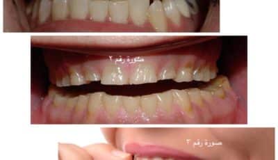 صك الأسنان – Teeth grinding