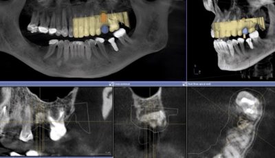 Dental Cone Beam CT