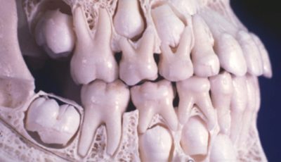 حقائق عن الأسنان اللبنية والدائمة يجب معرفتها_ Facts about Primary and Permenant Teeth