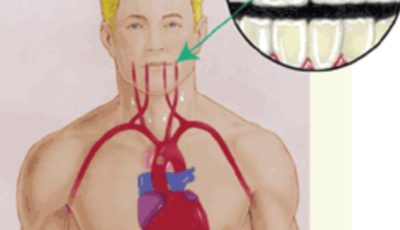 العلاقة بين أمراض القلب والتهابات اللثة_Heart Disease and Oral Health