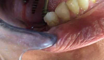 فشل الزرعات (الغرسات)السنيّة_Dental Implants Failure