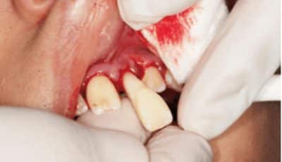 إعادة زراعة الأسنان_Immediate Replantation of Avulsed Tooth
