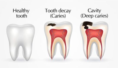 ما هو تسوس الأسنان_What is Tooth Decay