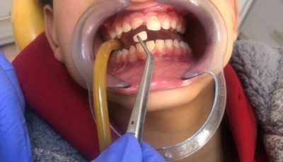 معالجة كسر الأسنان الأمامية عند الأطفال_Treatment of A Broken Central Incisor in Children