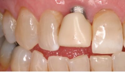 على أي عمر يمكن زراعة الأسنان؟_What’s the Right Age for Dental Implants