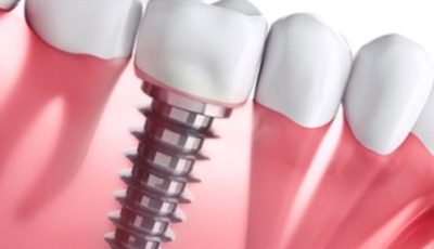 الغرسات السنية (زراعة الأسنان) – Dental Implants