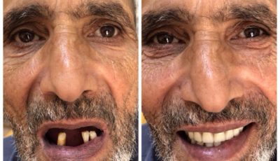 نصائح لتركيب طقم الاسنان-Advice for Complete Dentures