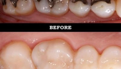 لماذا تعتبر الحشوات البيضاء أفضل من حشوات الفضة التقليدية؟-Amalgam Vs Composite filling