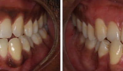 تصبّغ اللثّة-Gingival Pigmentation