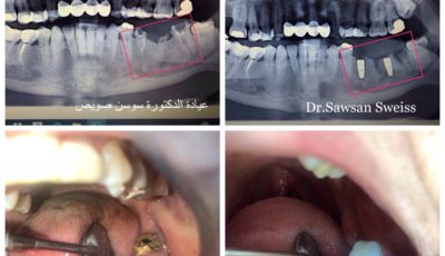 زراعة الأسنان الفورية-Immediate Implantation