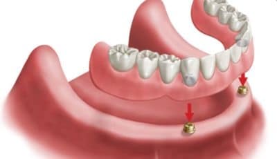 الطقم المثبت على الزرعات السنية-Overdenture