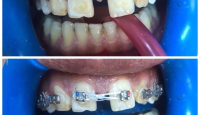 الفراغ بين الأسنان الأمامية-Diastema