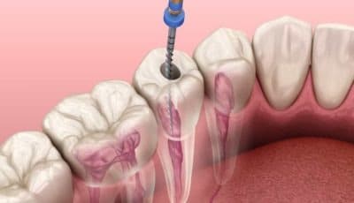 الألم بعد علاج العصب_Pain after Root Canal Treatment